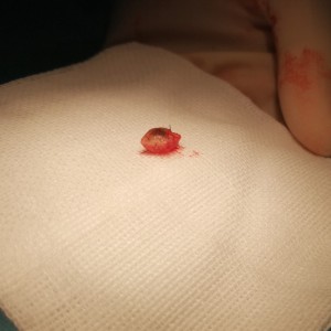游学秋 手术切痣经历