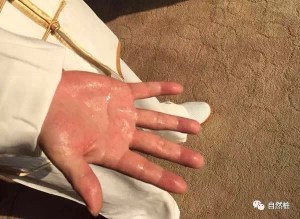 现在是祛湿的最佳时机,三步自查体内湿气!